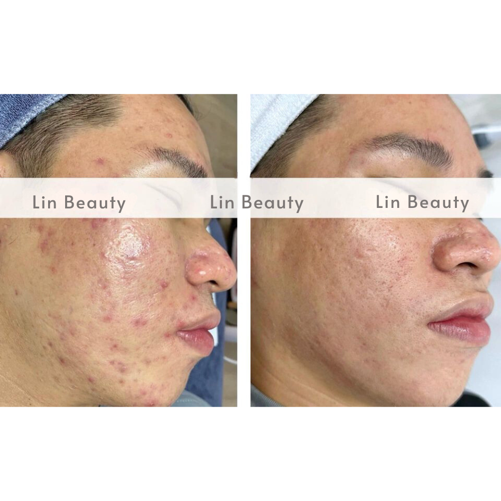 ket qua truoc va sau dieu ti mun 2