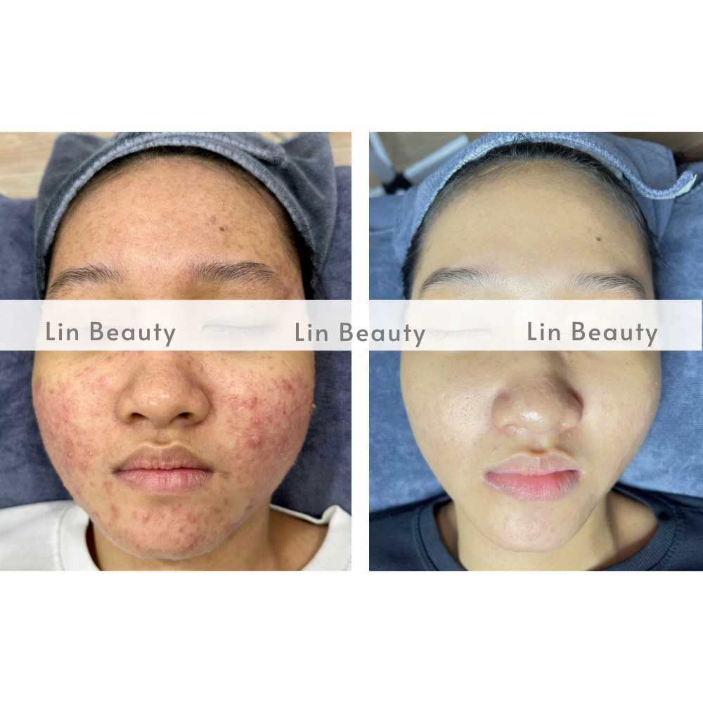 ket qua truoc va sau dieu ti mun 3