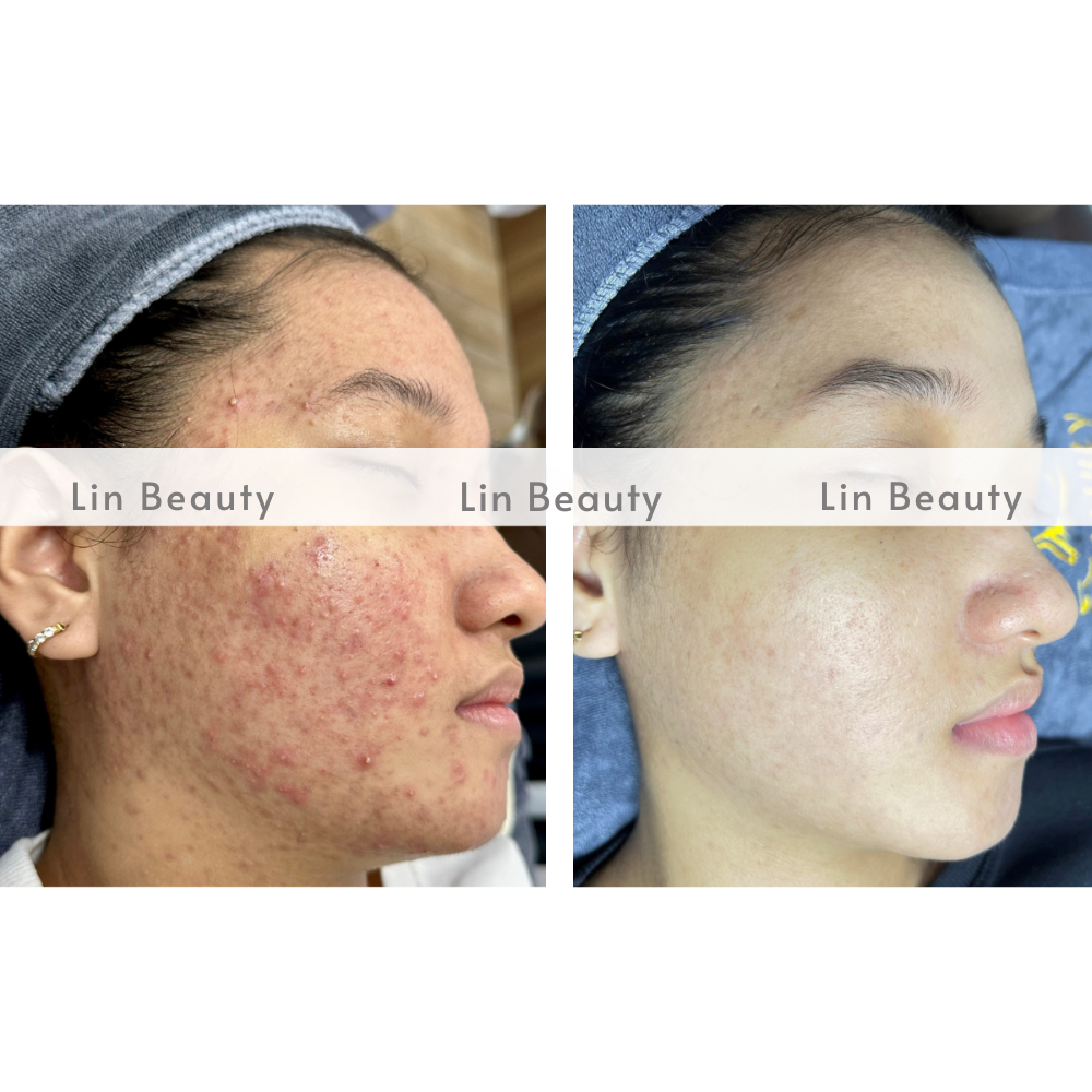 ket qua truoc va sau dieu ti mun